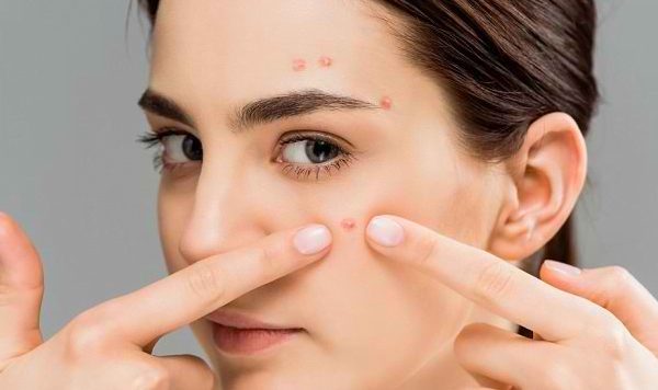 Cara Agar Jerawat Cepat Hilang Dalam Sekejap